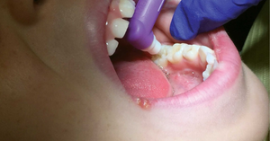 Use of GIC Cement in Pediatric Dentistry: Benefits and Applications