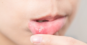 Cold Sores in Kids: Symptoms, Causes, and Effective Management