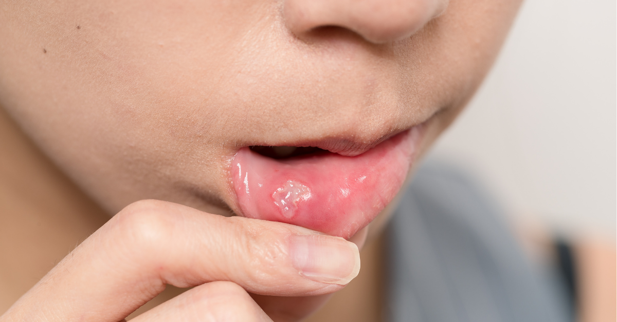 Canker Sores in Children: Causes, Symptoms, and Effective Treatment Options