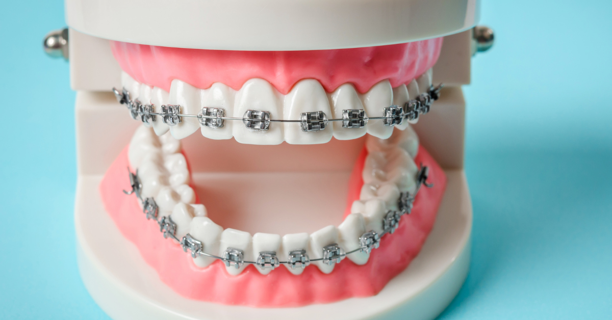 Dealing with tooth sensitivity after braces