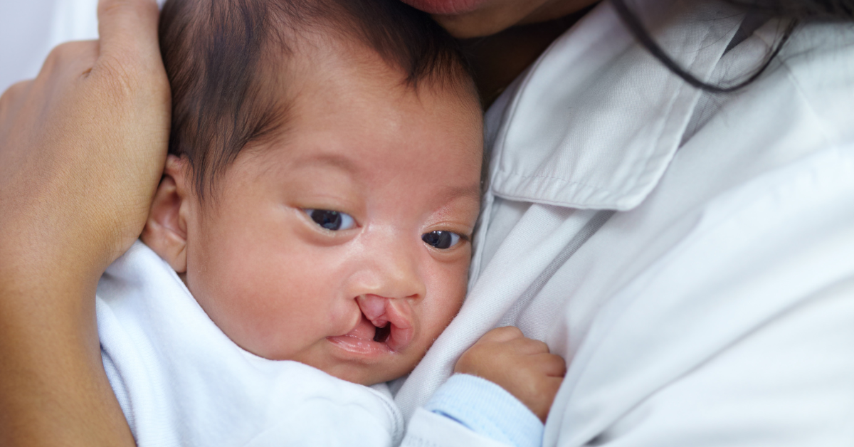 How to Effectively Manage Cleft Lip in Children: A Comprehensive Guide for Parents