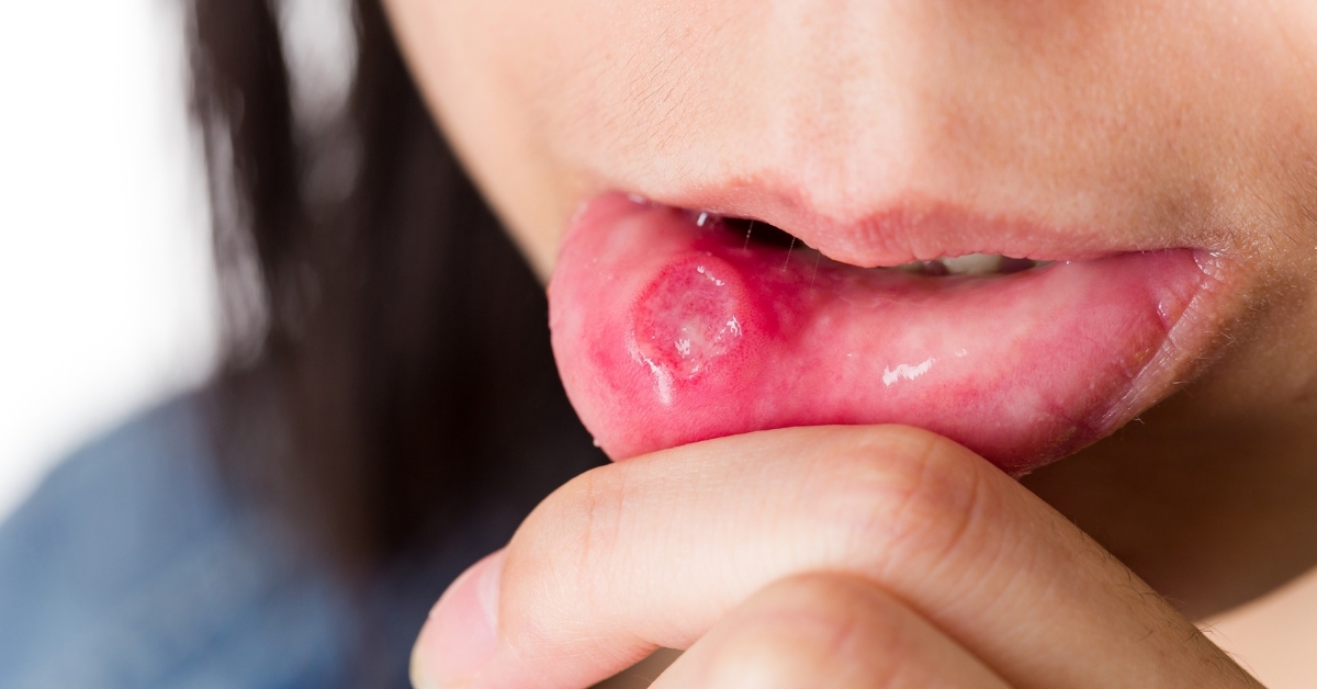 How to Manage Mouth Ulcers in Children