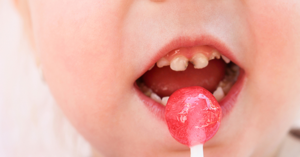 Incipient Caries and Kids: Early Signs and Prevention for Healthier Smile