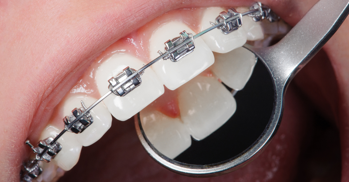 Managing Pain and Discomfort from Braces in Children