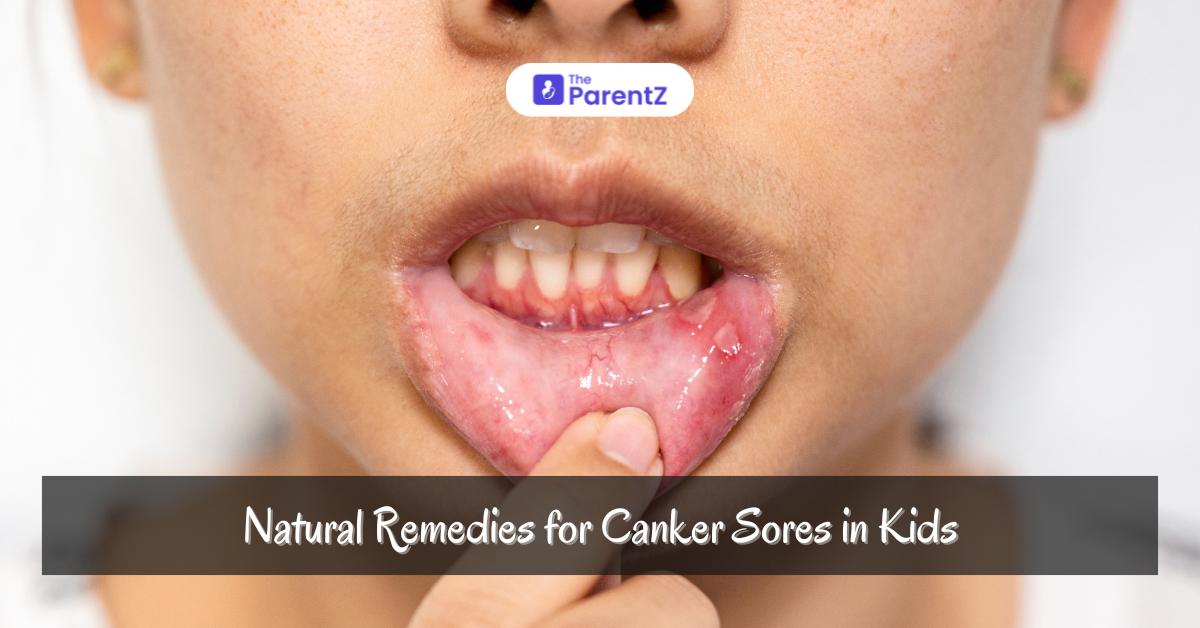 Natural Remedies for Canker Sores in Kids