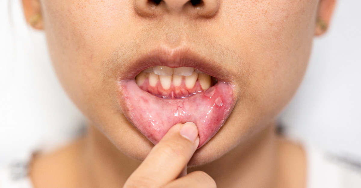 Natural Remedies for Canker Sores in Kids