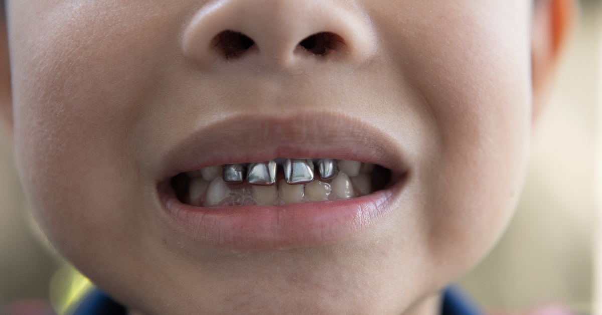 Stainless Steel Crowns in Children: The Best Choice for Pediatric Dental Care