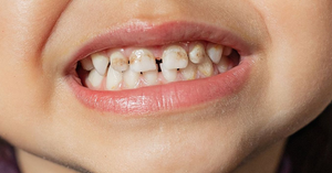 Understanding Molar Hypomineralization in Kids