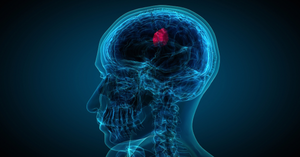 Understanding Pediatric Brain Tumors: Symptoms and Treatment