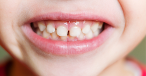 Why Do Some Kids Have Gaps in Their Teeth? 