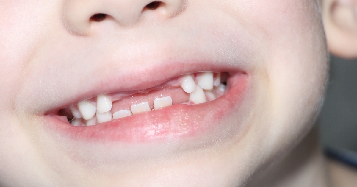 Why Milk Teeth are Important for Future Dental Health 