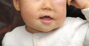 Understanding Cherubism in Children: Early Detection and Dental Care