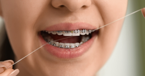 Best Ways to Floss with Braces: Techniques, Tools, and Tips