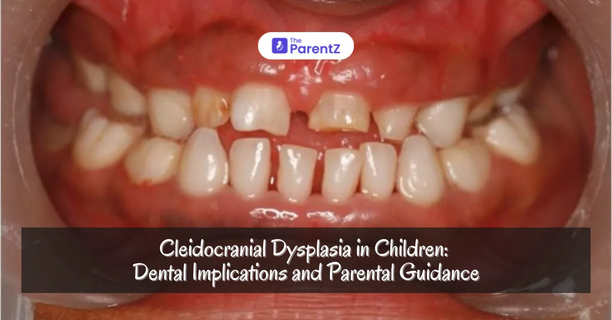 Cleidocranial Dysplasia in Children: Dental Implications and Parental Guidance