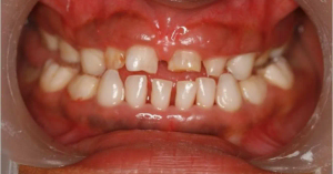 Cleidocranial Dysplasia in Children: Dental Implications and Parental Guidance