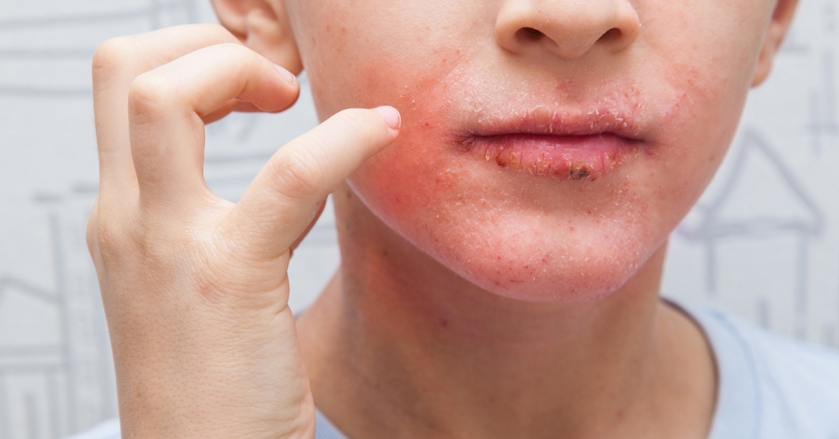 Managing Psoriasis in Kids: Treatment and Care