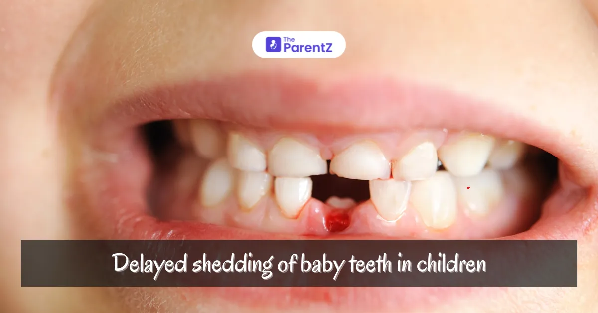 Understanding Delayed Shedding of Baby Teeth in Children