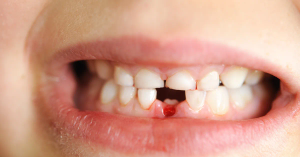 Understanding Delayed Shedding of Baby Teeth in Children