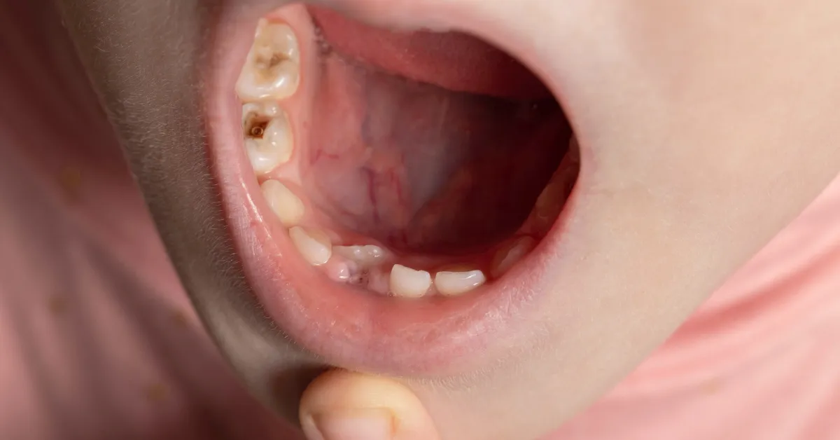 Dangers of Dental Neglect in Children