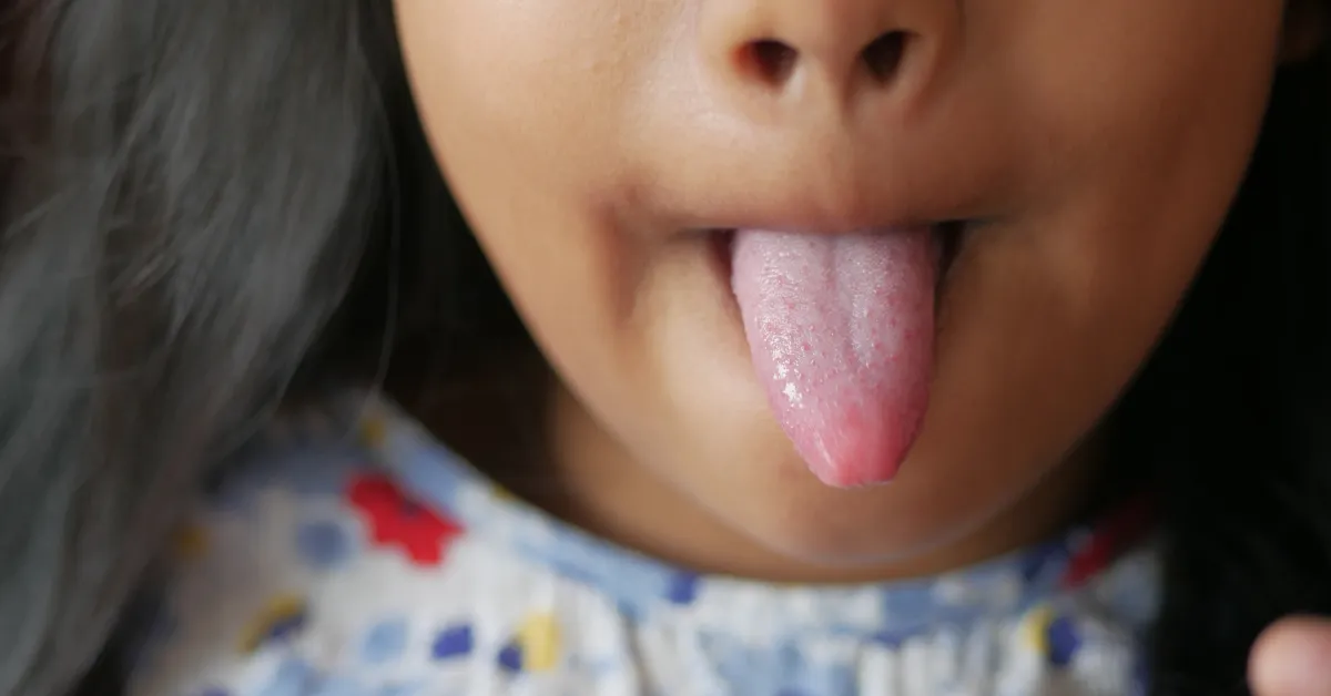 Tongue Health: Why It Matters