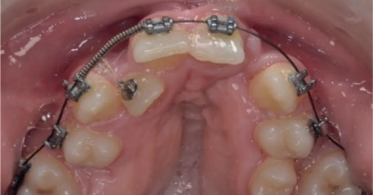 Understanding Craniofacial Syndromes and Dental Deformities: Causes, Diagnosis, and Treatment Options