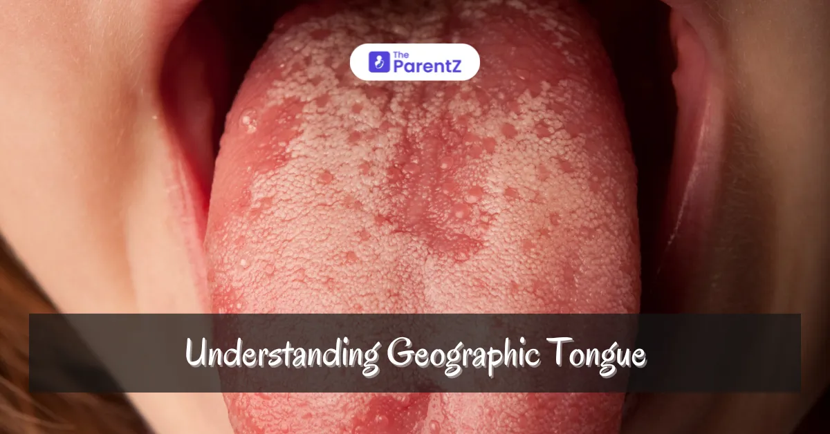 Understanding Geographic Tongue