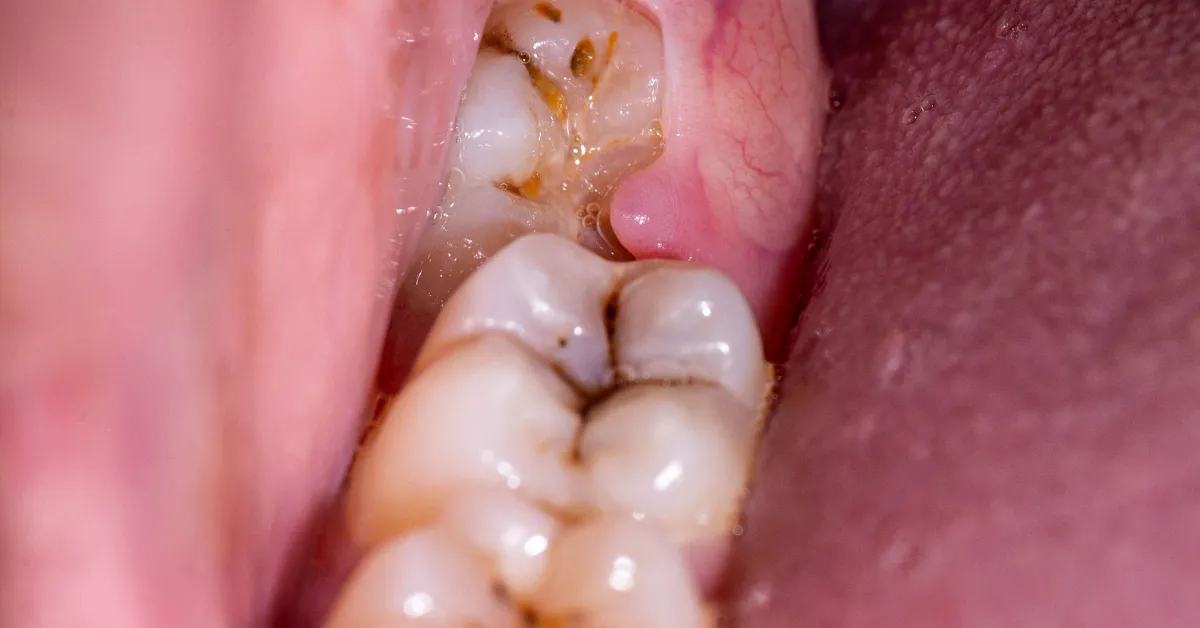 Wisdom Tooth Infection in Children: Signs and Symptoms