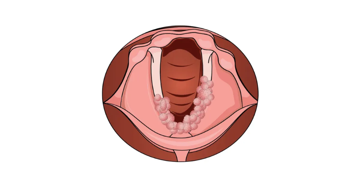 Juvenile Papillomatosis in Children: Causes, Symptoms, and Treatment