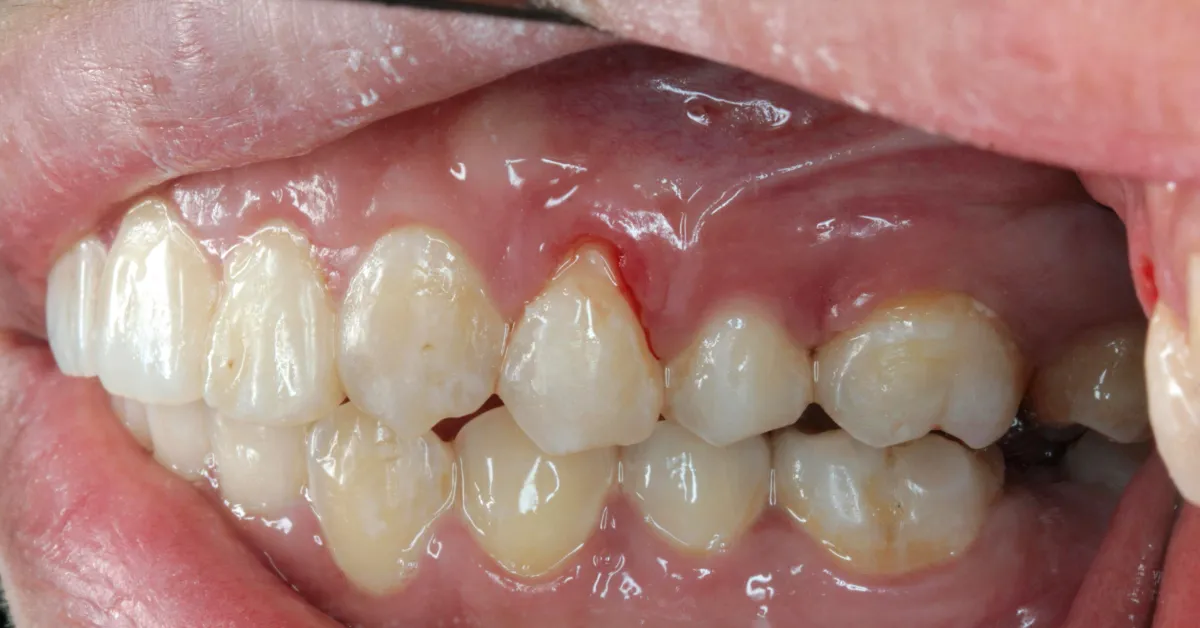 What  is Gum Recession: Causes, symptoms and treatment options