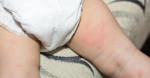 Diaper Rashes in Newborn Babies: Causes, Treatment, and Prevention