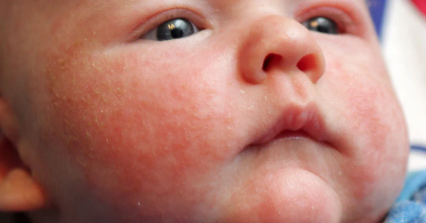 Eczema in Kids: Symptoms, Triggers, and Treatment