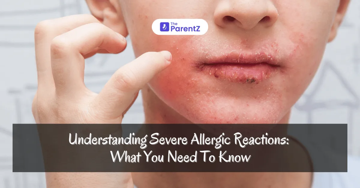 Understanding Severe Allergic Reactions: What You Need To Know