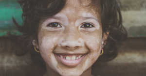 Vitiligo in Children: Causes, Symptoms, Diagnosis, and Treatment Options