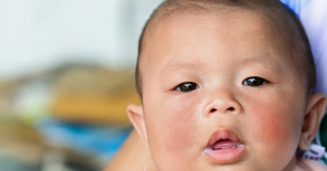 Skin Allergies In Babies: Types, Treatment And More