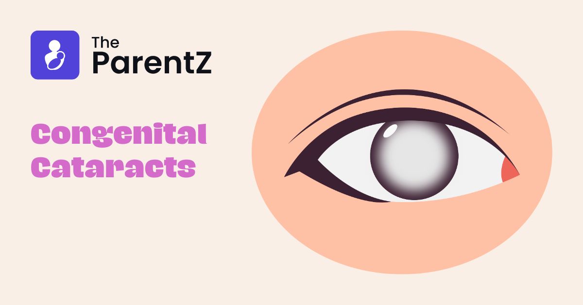 Congenital Cataracts