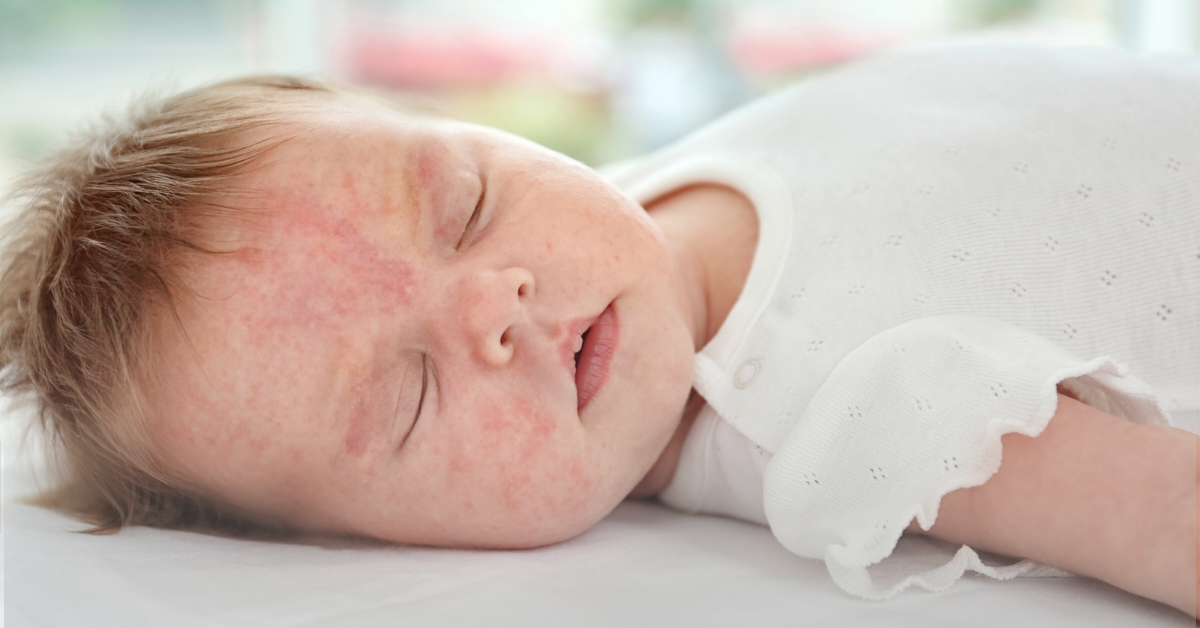 Dealing with Baby Eczema: Treatments and Care