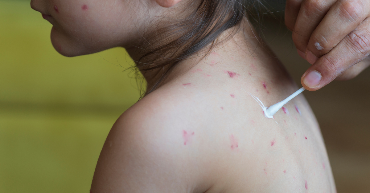 Monkeypox and Kids: A Parent's Guide to Staying Informed and Calm