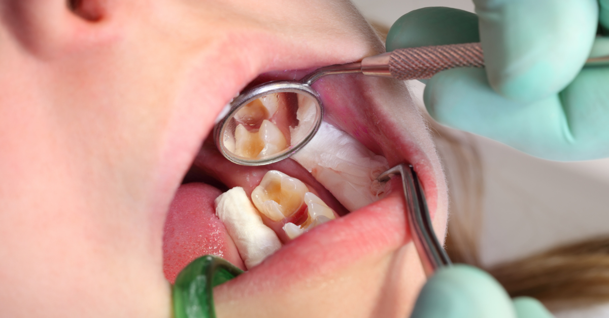 Preventing Cavities in Children: Effective Strategies