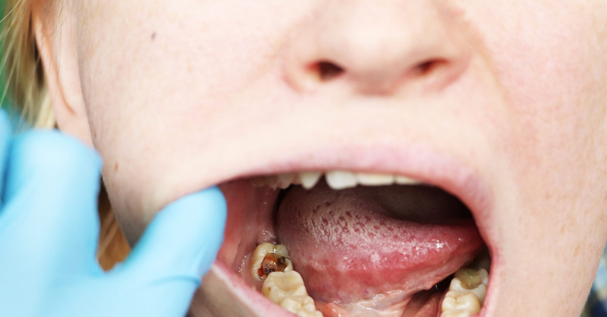 The Link Between Diet and Dental Cavities In Kids